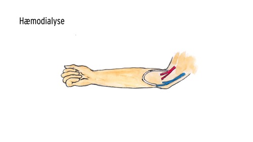 Tegning af en arm med indopereret graft